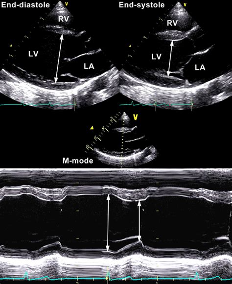 2d lv|Left Ventricular Dimensions .